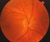 Optic Disc Hypoplasia