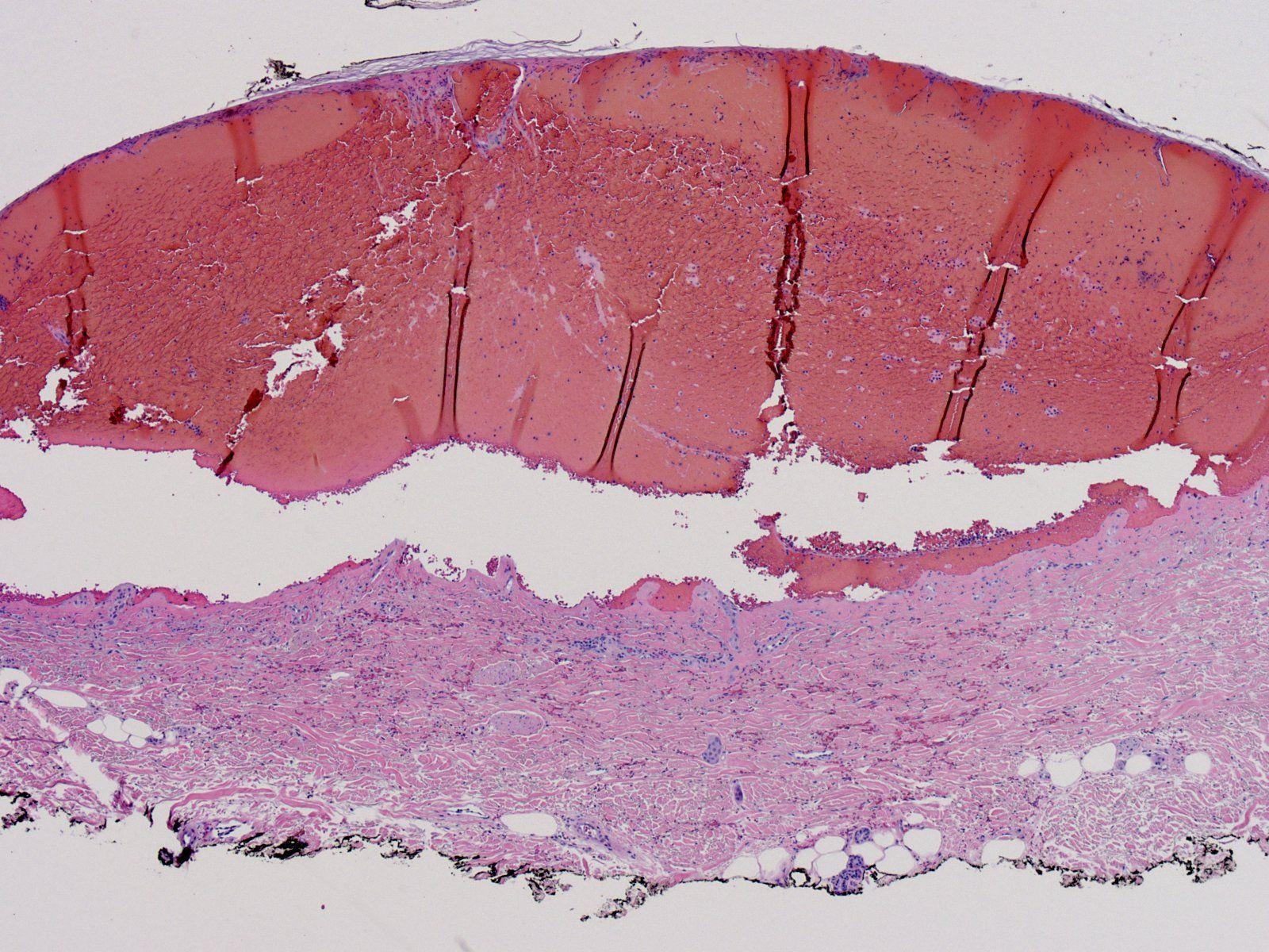 Histopathology, enoxaparin dermatosis 