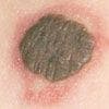 Congenital Nevomelanocytic Nevus