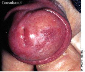 Pseudoepitheliomatous Hyperplasia