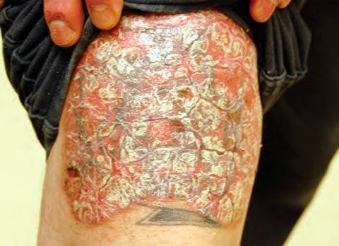 Chronic Plaque Psoriasis