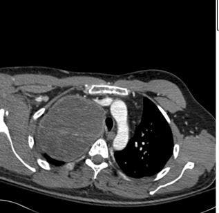 Worsening Shoulder Pain in a Man After a Fall on the Ice  