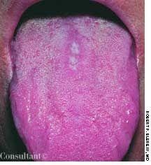 Median Rhomboid Glossitis