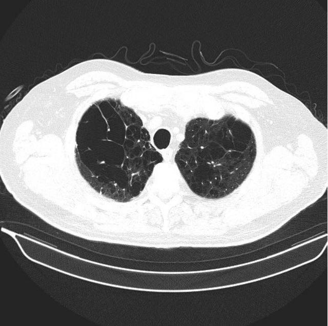 A Case of Worsening Dyspnea and Cough