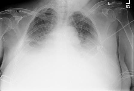 Pulmonary edema