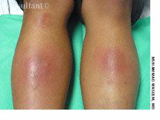 Erythema Nodosum on Shins of a 16-Year-Old Girl