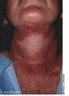 Berloque Dermatitis