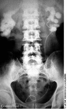 Bilateral Staghorn Calculi