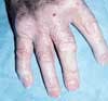 Rheumatoid Arthritis: Cutaneous Lesions 