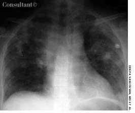 Progressive Dyspnea