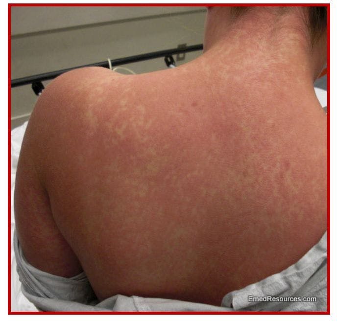 Fever, Rash, and Swollen Nodes in a Young Woman 