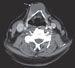 Thyroglossal Duct Cyst