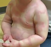 1-Year-Old With "Bullseye" Rash