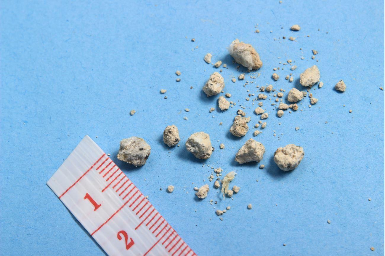 ADPKD does not increase kidney stone risk says hospital data 