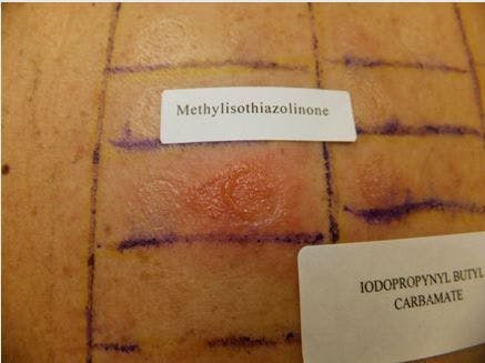  Bullous reaction to methylisothiazolinone