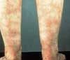 Livedo Reticularis: A Classic Presentation