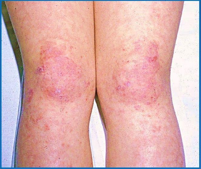 Dermatomyositis Quiz: 8 Key Questions