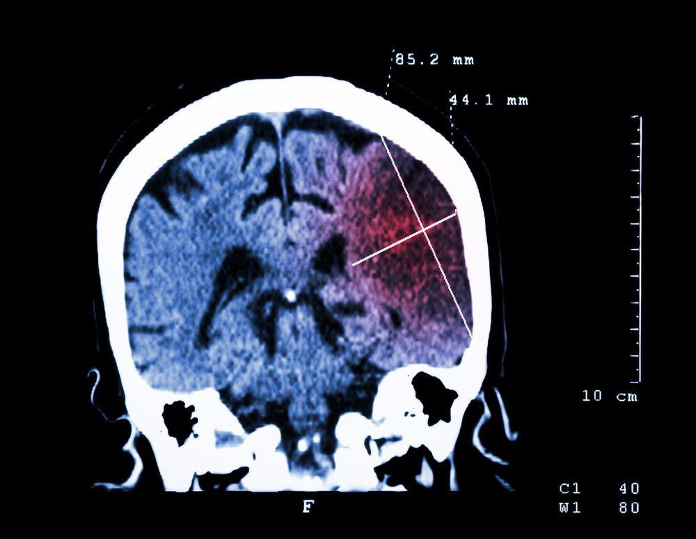 Risk of Stroke Mitigated by Even Low Levels of Physical Activity / image credit stroke: ©Puwadol Jaturawuttichai shutterstock