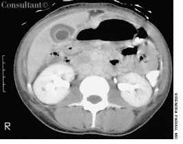 Acalculous Cholecystitis