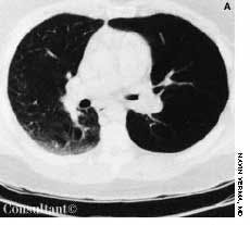 Wheezing Secondary to Obstructing Endobronchial Tumor