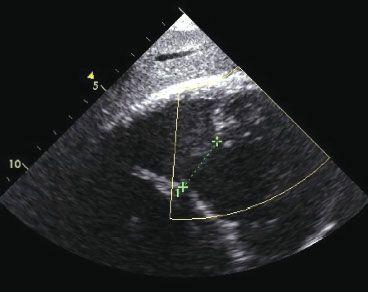 Myocarditis