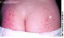 Contact Dermatitis to Diaper Material 