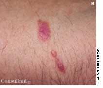 Lichen Planus Manifesting with Lingual Burning and Stinging