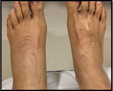 Unilateral leg edema, Baker's cyst, DVT 