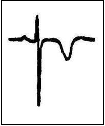 The Inverted T Wave: Differential Diagnosis in the Adult Patient 