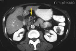 Superior Mesenteric Vein Thrombosis and Abdominal Pain