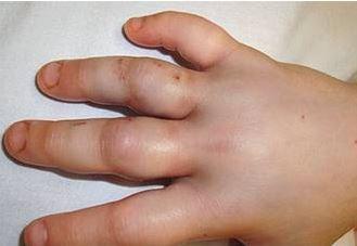 Swollen Hands-What’s Biting?