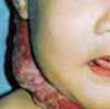 Cavernous Hemangiomas