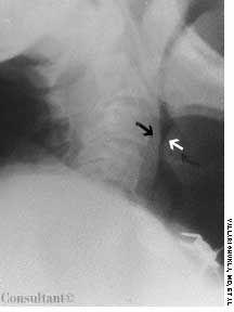 Acute Epiglottitis