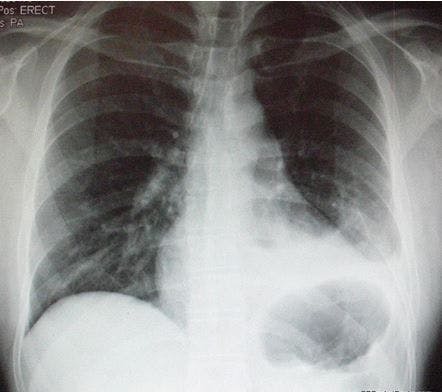 Chest Pain After Hemopneumothorax