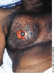 Inflammatory Breast Cancer