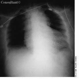 Aortic Dissection