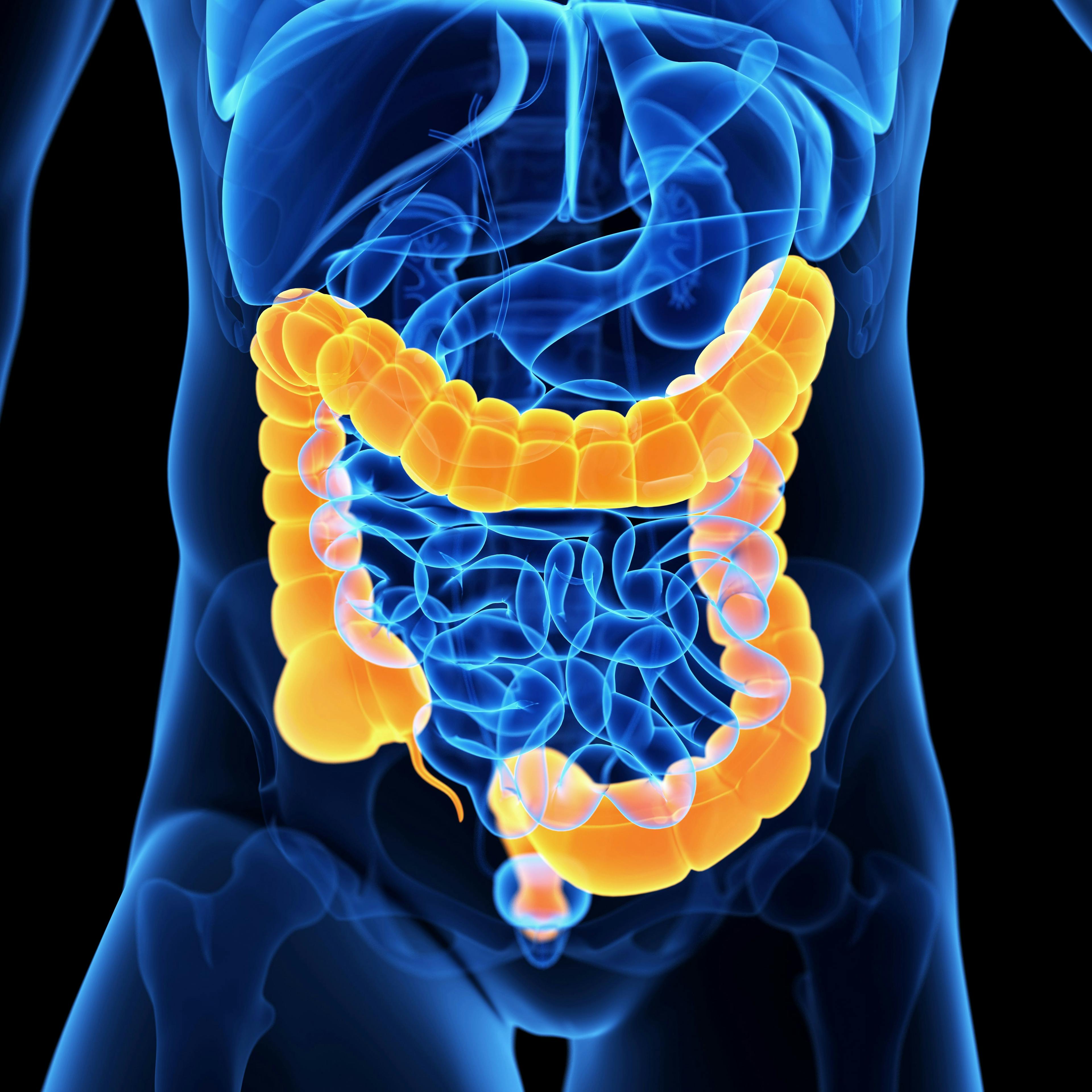 Bowel Preparation Understanding Major Barrier to Completion of Colonoscopy