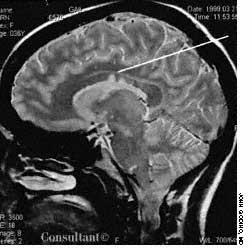 Multiple Sclerosis