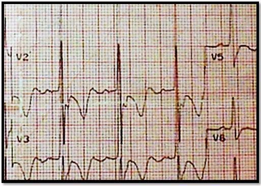 Pulmonary emoblism 