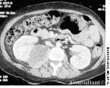 Psoas Abscess