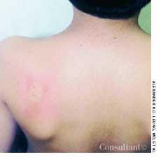 Molluscum Conagiosum in a 6-year-old Boy