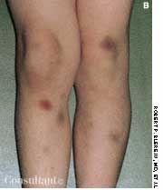 Immunologic Idiopathic Thrombocytopenic Purpura