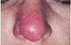 Nasal Cellulitis: MRSA Infection of the Nose 