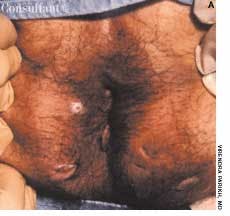 Complex Anorectal Fistula