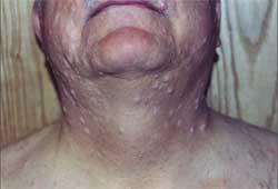 Neurofibromatosis Type I