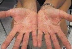 Allergic Contact Dermatitis from Black Rubber Mix