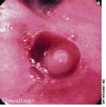 Squamous Cell Carcinoma of the Lung