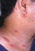 Images of Herpes Zoster