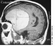 Meningioma