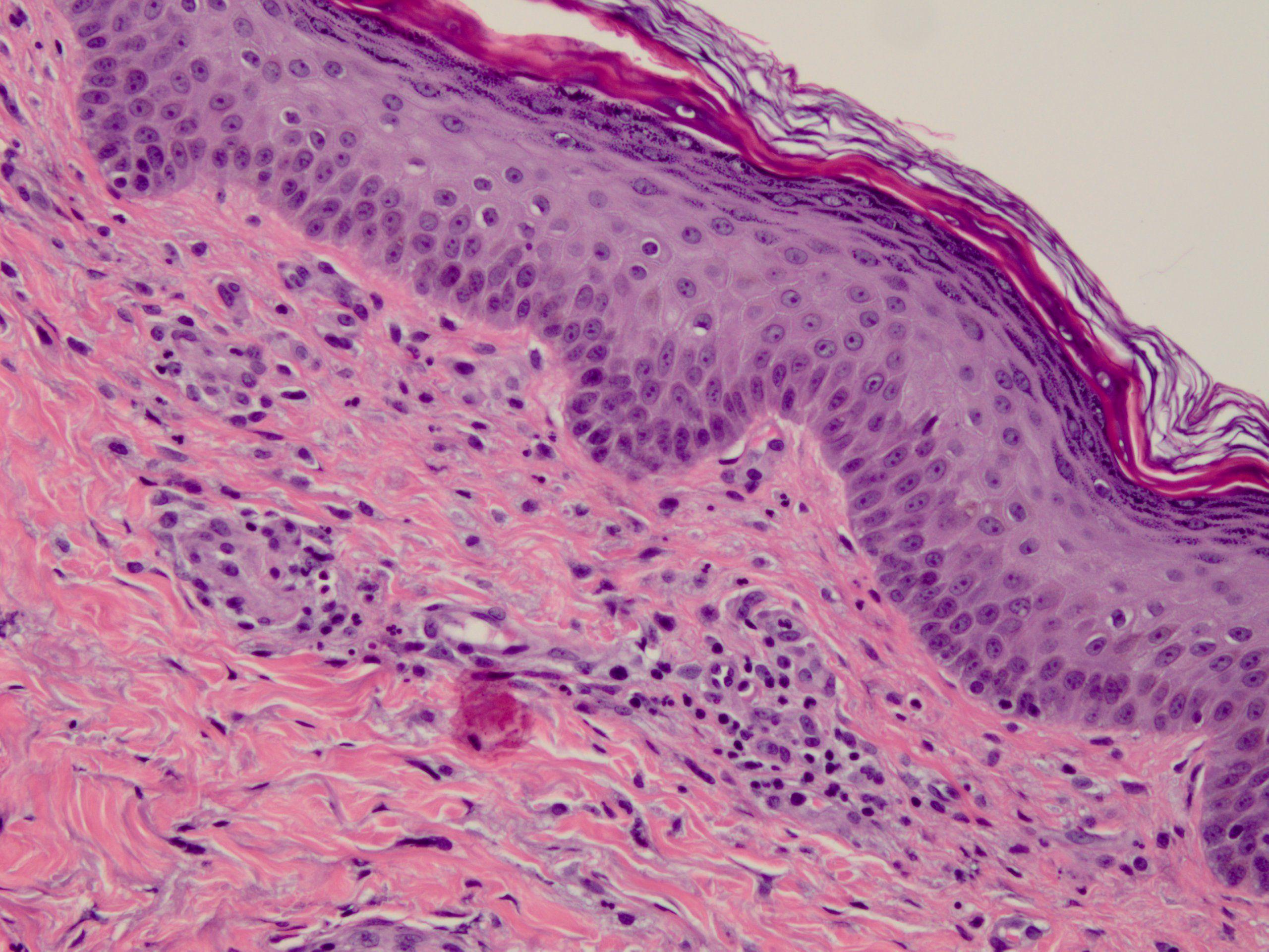 cutaneous leukocytoclastic vasculitis 